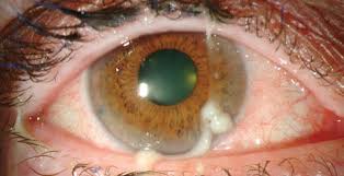 Image result for lesion sclera