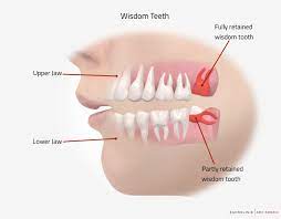 You should not drive for 24 hours. Wisdom Tooth Surgery In Hamburg Germany Zahnklinik Abc Bogen