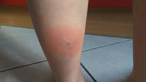 We did not find results for: Pique Par Une Tique Leur Fils Contracte La Maladie De Lyme Des Parents Racontent