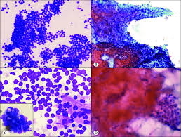 A B Hyperplastic Nodules With Pseudopapillary Formations Some Download Scientific Diagram