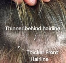 Thinning along the hairline or temples is more than likely the result of either traction alopecia, excessive hairstyling habits, genetic hair loss, or frontal fibrosing, which is a form of lichen. Female Pattern Hair Loss Very Front Hairline Often Unaffected Donovan Hair Clinic