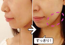 メディリフト before after 美容クリニック 美容 ヤーマン