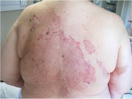 It was the first thing that popped up, and i was terrified. A Persistent Rash On The Back Chest And Abdomen Photo Quiz American Family Physician