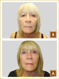 Cosmetic Surgery, Plastic Surgery in Nottingham, Nottinghamshire, Derby,  Derbyshire