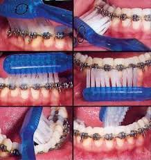 Learn how to properly brush and floss your teeth with braces. Pin On Dental Health Tips Education