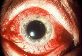 Image result for Acute Red Eye