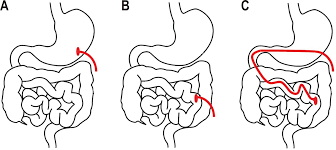 Image result for Enterostomy