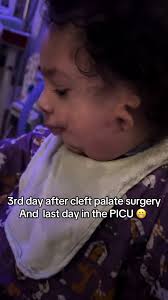 Treacher Collins Surgery Part 2