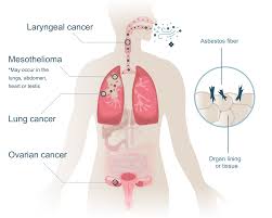 Almost every case of mesothelioma is caused by exposure to asbestos. Asbestos Cancer Mesothelioma Lung Cancer More