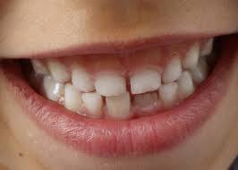 Se aplică ulei de cuișoare pe dintele afectat: DinÈii De Lapte CreÈterea Ingrijirea CorectÄ A Acestora Èi Prima VizitÄ La Medicul Dentist Denttaglio