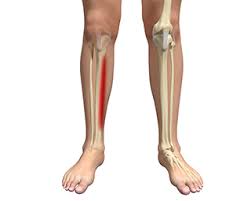Image result for Shin Splints