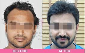 Hair Transplant Clinic In Delhi Hair Transplant Cost Hair Transplant In India Best Hair Transplant