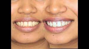 How To Whiten Teeth Diy Turmeric And Coconut Oil Youtube