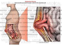 Find the perfect abdominal anatomy stock photos and editorial news pictures from getty images. Abdominal Hernia Anatomy Of Female Lateral View Medical Art Works