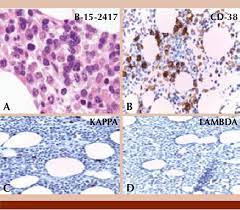 Bone Marrow Biopsy A There Is Interstitial Involvement With Myeloma Download Scientific Diagram