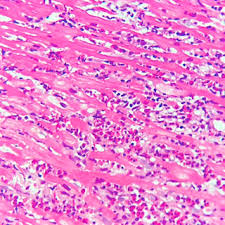 Por lo general es debida a una infección viral o bacteriana, y se presenta como dolor de pecho, signos repentinos de insuficiencia cardíaca y muerte súbita. Pdf Miocarditis Eosinofilica Como Causa De Disfuncion Ventricular Izquierda Reversible