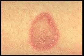 Pin On Lichen Planus Treatment