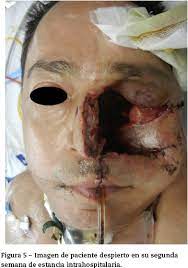 5,10 la mucormicosis se puede clasifi car en: Mucormicosis Rinocerebral De Origen Dental Reporte De Un Caso Clinico Y Revision De La Literatura
