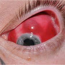 Eye tattoo leads to removal of the eye also in 2017, paul freund, md, and mark greve, md, from the university of alberta in canada reported on a tragic case. Pdf A Case Of Episcleral Tattooing An Emerging Body Modification Trend Cornea And External Eye Diseases