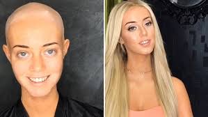 Perth model with Alopecia areata shares video of herself without a wig