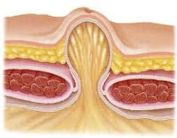 Herniile ombilicale pot aparea si la unii adulti, din cauza obezitatii, sarcinii sau alte simptome ale herniei, in special ale herniei complicate includ: Hernia OmbilicalÄ Dr Mihai HriÅ£cu