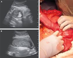 Image result for Intussusception