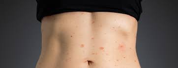 Image result for sweat rash on back
