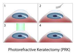 Über 7 millionen englischsprachige bücher. Laser Eye Surgery Chicago Il Midway Garfield Ridge Lasik Prk