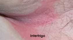 Image result for Intertrigo