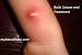 Ingrown Hair Boils