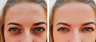 Check spelling or type a new query. How Does Microneedling Treat Dark Circles Under The Eyes Westover Hills Dermatology