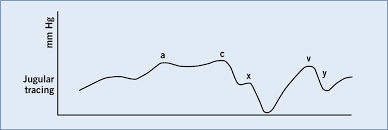 Assumptions of conventional linear cvp analysis. How To Perform Central Venous Pressure Measurement The Veterinary Nurse