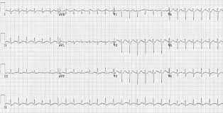 For suspected cases, consider consultation with cardiology for assistance with cardiac evaluation and management. Myocarditis Ecg Changes Litfl Ecg Library Diagnosis