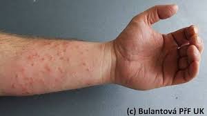 Image result for vyrážka u dětí