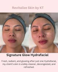 JULY PROMOTION!!! 🎆🎇 Look at her before and after, her skin looks more  smooth and clean and healthy. 🩷 Bring a friend and both get a deluxe,  relax facial for $65 dollars..