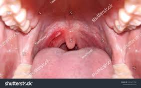 Image result for Canker sores symptoms roof of the mouth