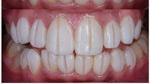 Porcelain veneers juga dilakukan dalam waktu kurang lebih 2 minggu. Berapa Harga Veneer Gigi Yang Biasa Dikerjakan Dokter Di Klinik