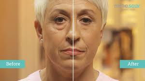 Remescar Tranensacke Unter Den Augen Sofort Reduzieren Dunkle Ringe Unter Den Augen Behandeln Remescar