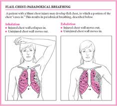 Flail Chest Http 4 Bp Blogspot Com 4xaleca8li8 Sf0wtdufffi Aaaaaaaaaje 3qj Jgvmomw S400 Ethereal Heaven Flail Chest Emt Study Nurse Nursing School Studying