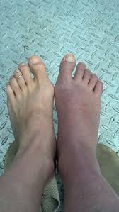 Pin On Lisfranc