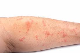 Image result for scabies in the groin area