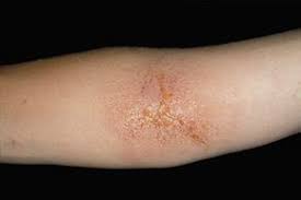 Image result for Rhus Dermatitis