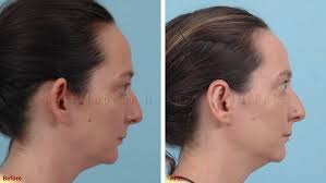 Otoplasty or Ear Surgery Photos