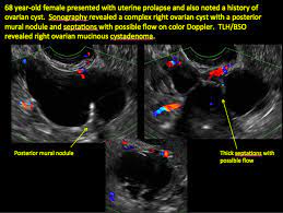 We did not find results for: Imaging The Suspected Ovarian Malignancy 14 Cases Mdedge Obgyn