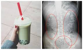 There are now over 800 shops in the u.s., mostly concentrated in new york and california. Doctor Discovers 100 Bubble Tea Pearls In Girl S Abdomen Cafemom Com
