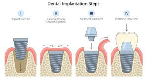 Image result for dental implant