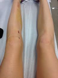 Pin On Knee Surgery Recovery