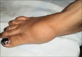 It was identical, says beth stump, 40, who. Giant Cell Tumor Of The First Metatarsal Siddiqui Ys Zahid M Sabir Ab Julfiqar J Can Res Ther
