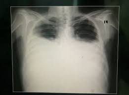 Loss of the costophrenic angle. Pleural Effusion Geeky Medics