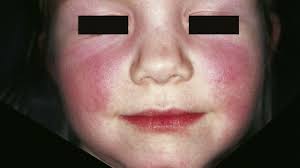 Ringelröteln sind extrem ansteckend und können sich deshalb innerhalb kurzer zeit sehr schnell ausbreiten. Erythema Infectiosum Altmeyers Enzyklopadie Fachbereich Dermatologie